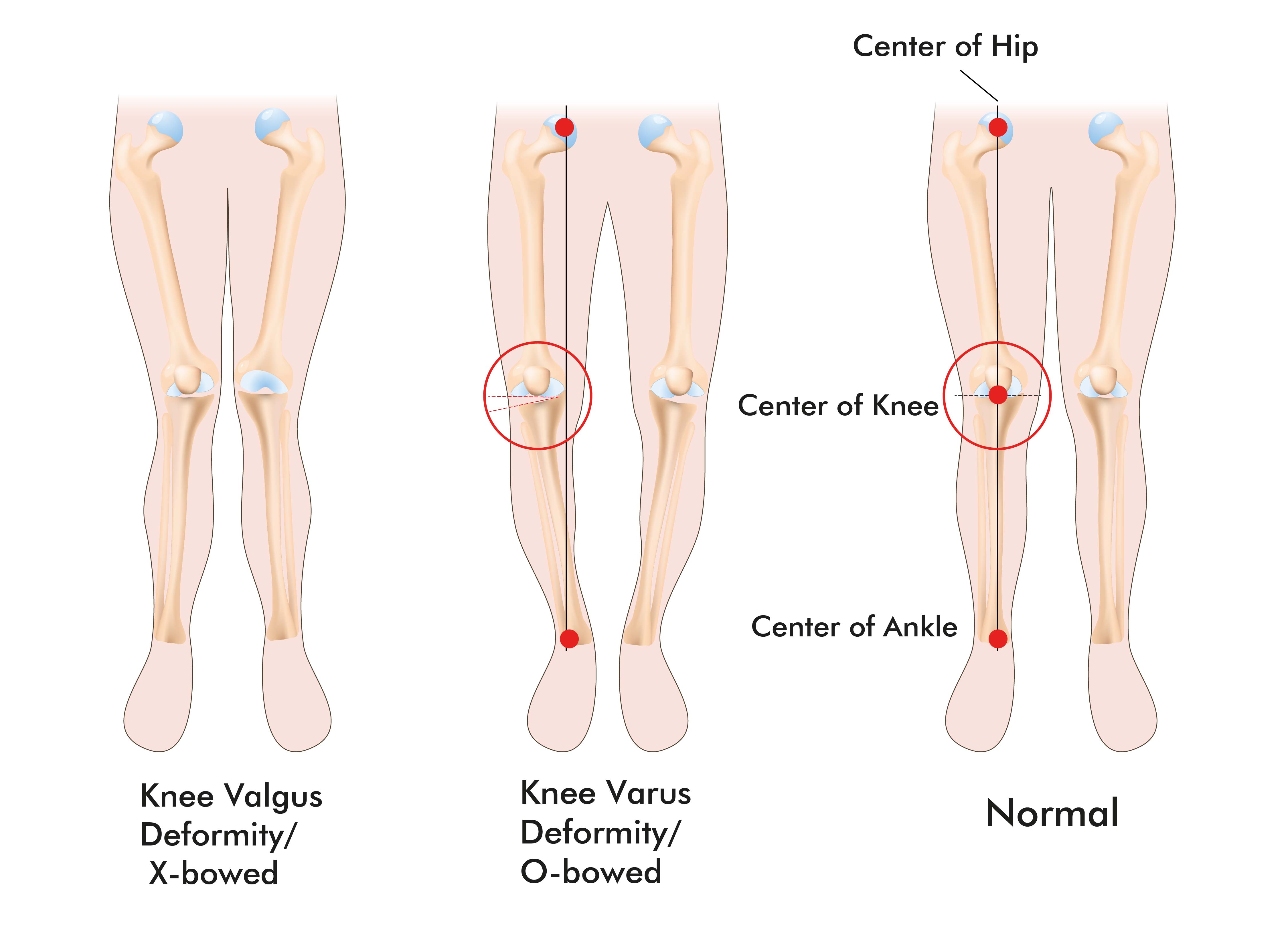 Deformity Correction: The Process  International Center for Limb